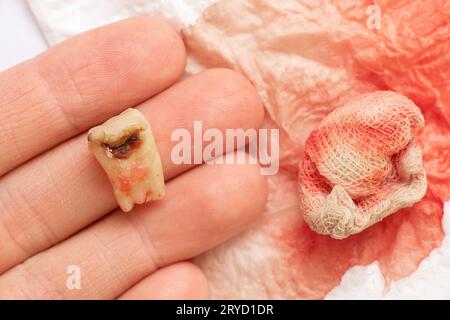 Ein Mädchen in der Hand hält einen extrahierten Zahn mit einem schwarzen Loch in der Mitte des Zahns, nah an dem Hintergrund eines Verbands mit Blut, in Stockfoto