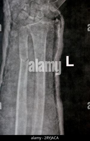 Ein Röntgenbild des rechten Unterarms (irrtümlich links auf dem Film geschrieben) zeigt eine Fraktur des unteren Teils der Ulna in der Besetzung für 4 Wochen und beginnt zu heilen Stockfoto