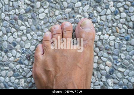 Zehennägel mit Pilzproblemen,Onychomykose, auch bekannt als Tinea unguium, ist eine Pilzinfektion des Nagels, Steinhintergrund. Stockfoto