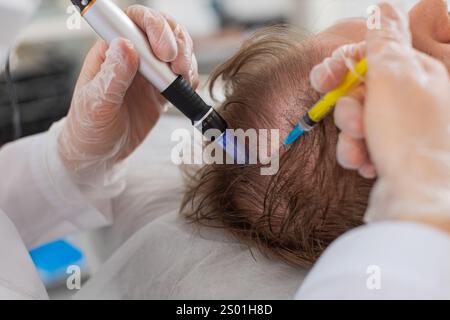 Alopezie. Der Haarausfall des Mannes verbessert die Regeneration der Wachstumsbehandlung, Dermapen-Mikroneedling, Vitamin-Exosomen-Plasmainjektionen. Trichologe Kosmetologe Arzt KopfKopfKopfhautverfahren fraktionelle Mesotherapie Stockfoto