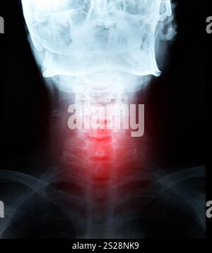 X-ray Image Film detail von Hals- und Red Zone Schmerz. Stockfoto