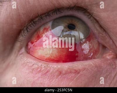 Nahaufnahme des blutunterlaufenen männlichen Auges Stockfoto