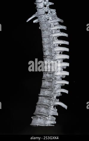 Spinale mrt-Bilder Stockfoto