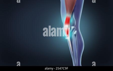 Tendonitis Knieschmerzen mit der Anatomie eines Skelettbeins und Darstellung der inneren Quadrizeps- und Petallarsehnenentzündung als schmerzhaftes Gelenk. Stockfoto