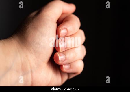 Nahaufnahme von Fingern und Nägeln gebissen. Gesundheit und medizinisches Konzept. Maniküre Artist. Bild für vorher und danach. Stockfoto