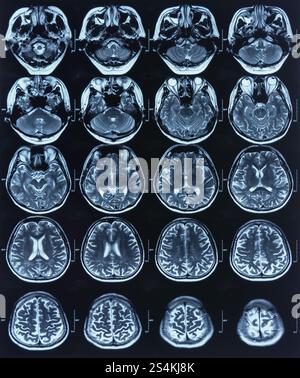 Röntgenbild des Patientengehirns mittels Computertomographie, mrt für die medizinische Diagnostik. Stockfoto