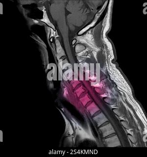 Sagittale Ansicht des Magnetresonanzbildes der MRT der Halswirbelsäule mit zervikaler spondylotischer Myelopathie, die Nackenschmerzen und -Schwäche verursacht. (Cervic Stockfoto