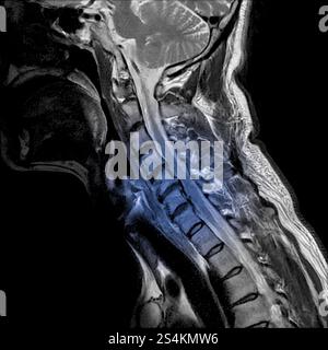 Sagittale Ansicht des Magnetresonanzbildes der MRT der Halswirbelsäule mit zervikaler spondylotischer Myelopathie, die Nackenschmerzen und -Schwäche verursacht. (Cervic Stockfoto