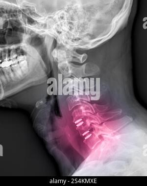 Projektionsröntgenbild der Halswirbelsäule mit anteriorer zervikaler Diskektomie und Fusion bei einem Patienten mit zervikaler spondylotischer Myelopathie. Stockfoto