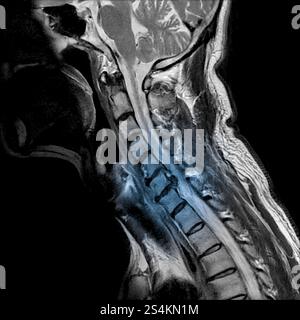 Sagittale Ansicht des Magnetresonanzbildes der MRT der Halswirbelsäule mit zervikaler spondylotischer Myelopathie, die Nackenschmerzen und -Schwäche verursacht. (Cervic Stockfoto