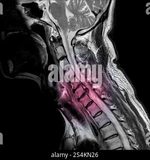 Sagittale Ansicht des Magnetresonanzbildes der MRT der Halswirbelsäule mit zervikaler spondylotischer Myelopathie, die Nackenschmerzen und -Schwäche verursacht. (Cervic Stockfoto