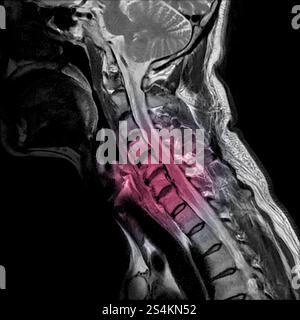 Sagittale Ansicht des Magnetresonanzbildes der MRT der Halswirbelsäule mit zervikaler spondylotischer Myelopathie, die Nackenschmerzen und -Schwäche verursacht. (Cervic Stockfoto