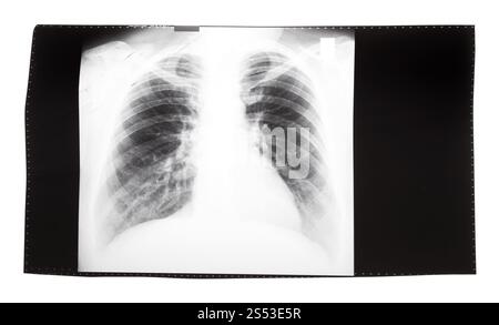 Film mit X-ray Image der Vorderansicht des menschlichen Thorax auf weißem Hintergrund Stockfoto