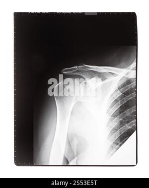 Film mit X-ray Bild von vorne Blick auf menschliche Schultergelenk auf weißem Hintergrund Stockfoto
