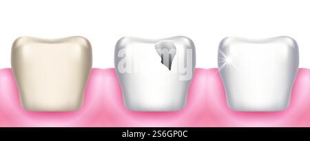 Zahnprobleme. Karies, Zahnerkrankungen, Infektionskaries und Schmelzzerstörung. Professionelle Reinigung oder Aufhellung. Realistische 3D-Stomatologie-Vektordarstellung. Krankheitsschmelz, Karies. Zahnprobleme. Karies, Zahnerkrankungen, Infektionskaries und Schmelzzerstörung. Professionelle Reinigung oder Aufhellung. Realistische 3D-Stomatologie-Vektordarstellung Stock Vektor