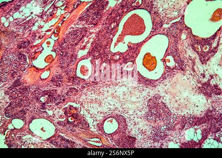 Gemischtumorerkranktes Gewebe 100x Stockfoto