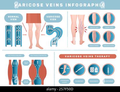 Krampfanfall-Infografik. Venöse Krankheit medizinische Gesundheitsprobleme mit menschlichem Blut venöse neue Vektor-Vorlage Satz Gesundheit Körper Thrombose und Behandlung Illustration. Krampfanfall-Infografik. Venöse Erkrankung medizinische Gesundheitsprobleme mit menschlichem Blut venösen neueren Vektor-Template-Set Stock Vektor