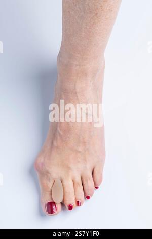 Ein Silikonseparator zwischen Grosszehe und Zeigezehe eines Fußes mit Hallux valgus Stockfoto