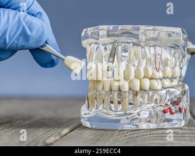 Detailliertes transparentes Implantatmodell mit einer Pinzette, die eine Prothese hält Stockfoto