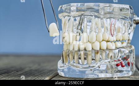 Detailliertes transparentes Implantatmodell mit einer Pinzette, die eine Prothese hält Stockfoto