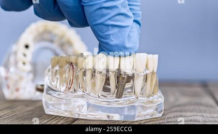 Nahaufnahme eines transparenten Implantatmodells mit Handschuhen zur Einstellung von Zahnprothesen Stockfoto
