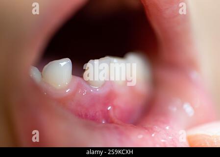 Wackelige Vorderzähne des Kindes (Babyzähne) Stockfoto