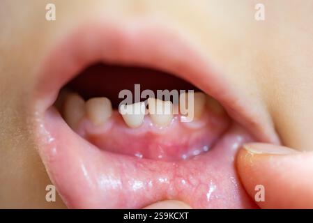 Wackelige Vorderzähne des Kindes (Babyzähne) Stockfoto