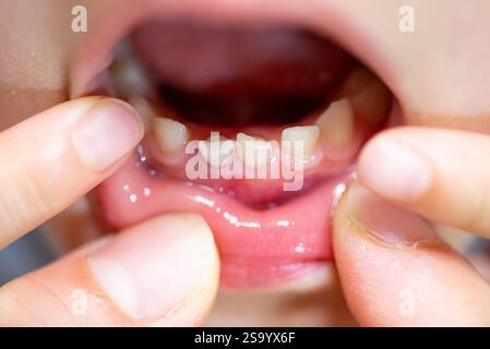 Wackelige Vorderzähne des Kindes (Babyzähne) Stockfoto