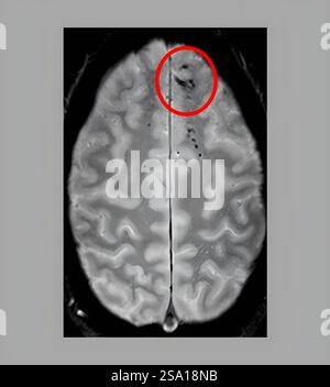 Traumatische Mikroblutungen treten bei MRT-Scans als dunkle Läsionen auf und deuten auf Schäden an den Blutgefäßen des Gehirns nach Kopfverletzung hin. Brain Microbleed 016555 010 Stockfoto