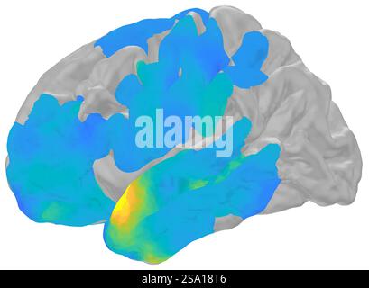 In einer Studie mit Epilepsiepatienten fanden Forscher der National Institutes of Health heraus, dass Sekundenbruchteile, bevor wir uns an diese Ereignisse erinnern, winzige elektrische Wellen, sogenannte Rippeln, durch wichtige Teile unseres Gehirns fließen können, die unsere Erinnerungen speichern und die Voraussetzungen für eine erfolgreiche Wiederauffindung schaffen. Elektrische Gehirnwellen, die mit Memory 016555 017 verknüpft sind Stockfoto