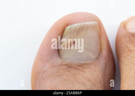 Hochwinkelaufnahme einer Finger-Onychomykose mit Pilznagelinfektion isoliert auf weiß Stockfoto