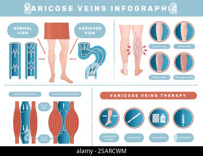 Krampfanfall-Infografik. Venöse Krankheit medizinische Gesundheitsprobleme mit menschlichem Blut venöse neue Vektor-Vorlage Satz Gesundheit Körper Thrombose und Behandlung Illustration. Krampfanfall-Infografik. Venöse Erkrankung medizinische Gesundheitsprobleme mit menschlichem Blut venösen neueren Vektor-Template-Set Stock Vektor