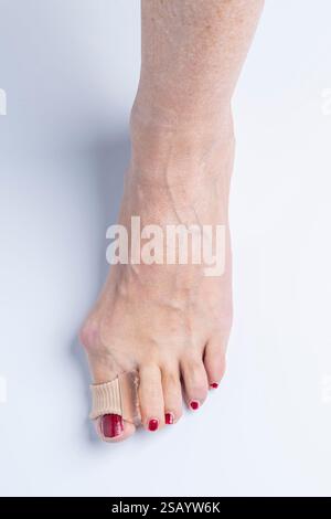 Silikonabscheider mit elastischem Ring, zwischen Grosszehe und Zeigefinger eines Fusses mit Hallux valgus eingesetzt Stockfoto