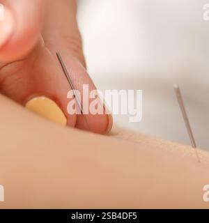 Akupunkturist stimuliert Magenakupunkturpunkte zur Behandlung von Ödemen (Flüssigkeitsretention). Stockfoto