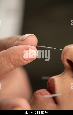 Akupunkturtherapie gegen das Rauchen. Stockfoto