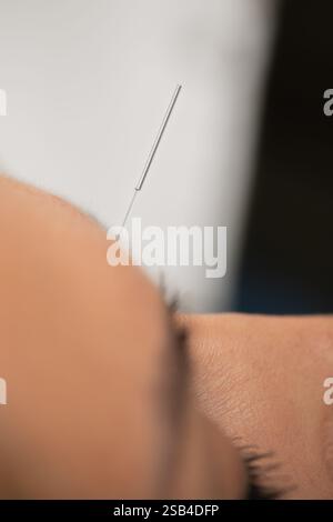 Akupunkturtherapie gegen das Rauchen. Stockfoto