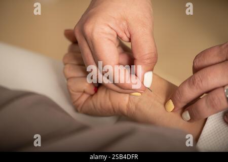 Akupunkturbehandlung bei Raucherentwöhnung. Stockfoto