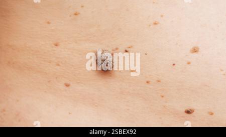 Muttermale und Muttermale auf menschlicher Haut-Nahaufnahme. Stockfoto