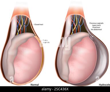 Hydrozele Hoden. Anreicherung von seröser Flüssigkeit in einer Körperhöhle. Hodenanatomie Medizinische Illustration. Der Querschnitt Des Männlichen Reproduktionssystems Stock Vektor