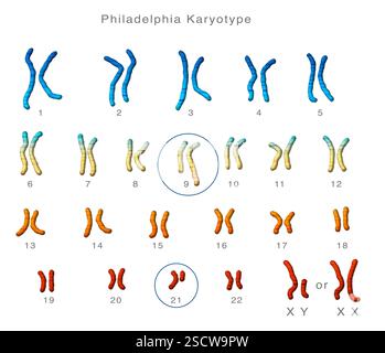 Philadelphia-Karyotyp. Abbildung eines männlichen oder weiblichen Karyotyps (Chromosomensatz) mit einem defekten Chromosom auf Paaren 9 und 22. Dies kann zu chronischer myeloischer Leukämie (CML) führen. Die linken Chromosomen der Paare 22 und 9 sind normal, während ein translokationaler Defekt das defekte Chromosom 9 größer und das defekte Chromosom 22 kleiner machte. Stockfoto