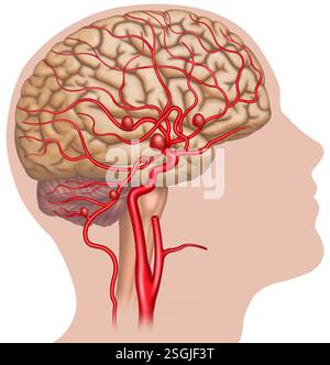 Diagramm des menschlichen Kopfes und der Hauptarterien des Gehirns. Es zeigt ein Aneurysma, eine anormale Dilatation in der Wand der Blutgefäße. Stockfoto