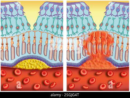 Diagramm der (AMD) Augenkrankheit. Altersbedingte Makuladegeneration, degenerative Makuladegeneration der Makula, zentraler Bereich der ​​the Netzhaut. Stockfoto