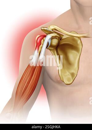 Illustration der Schultertendonitis. Eine Entzündung der Rotatorenmanschette oder der Bizepssehnen führt zu Schmerzen, Steifigkeit und eingeschränkter Mobilität. Stockfoto