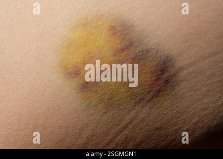 Ein Nahaufnahme-Bild, das einen Bluterguss auf der Haut zeigt, der durch einen Hundebiss verursacht wurde und die Verfärbung und Textur des betroffenen Bereichs hervorhebt Stockfoto