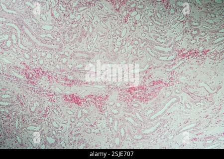 Poly Nephritis, Gewebe unter dem Mikroskop 100x Stockfoto