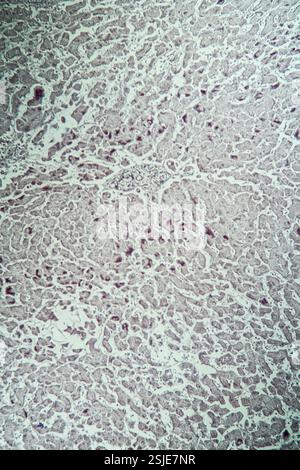 Erkranktes Lebergewebe unter dem Mikroskop 100x Stockfoto