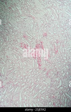 Poly Nephritis, Gewebe unter dem Mikroskop 100x Stockfoto