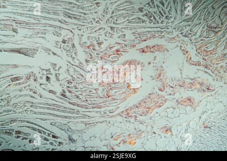 Erkranktes Gewebe unter dem Mikroskop 200x Stockfoto
