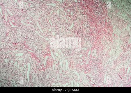 Poly Nephritis, Gewebe unter dem Mikroskop 100x Stockfoto