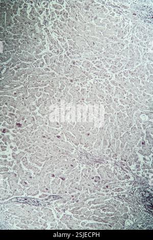 Lebererkranktes Gewebe unter dem Mikroskop 100x Stockfoto